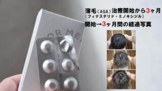 【記録用/3ヶ月経過】クリニックフォアの発毛ライトプラン（フィナステリド／ミノキシジル合剤） 