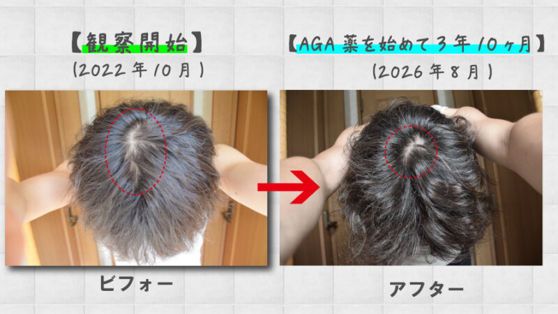 【写真あり】薄毛（AGA）治療を始めて3年10ヶ月の経過報告！発毛剤からAGA薬まで効果を実感！ 