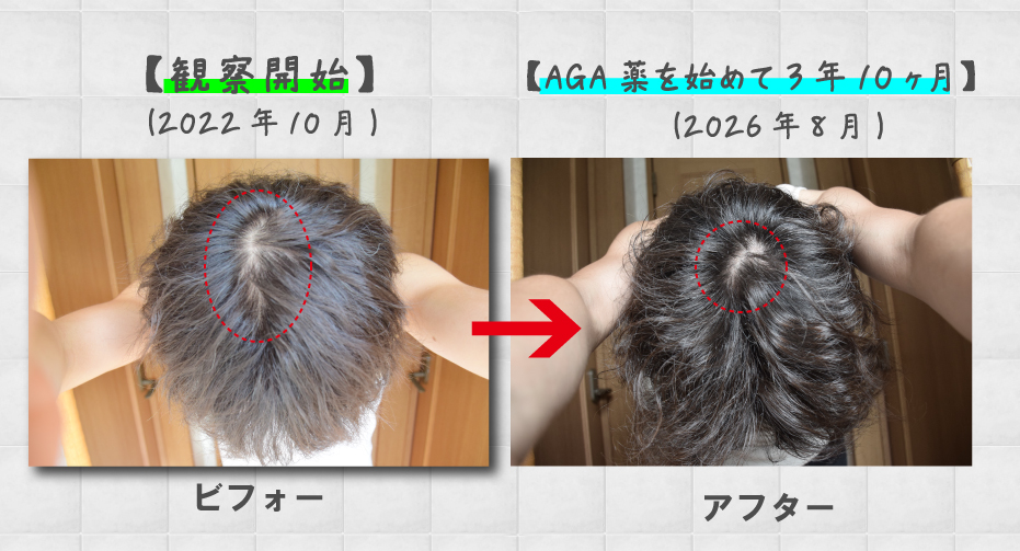 【写真あり】薄毛（AGA）治療を始めて3年10ヶ月の経過報告！発毛剤からAGA薬まで効果を実感！