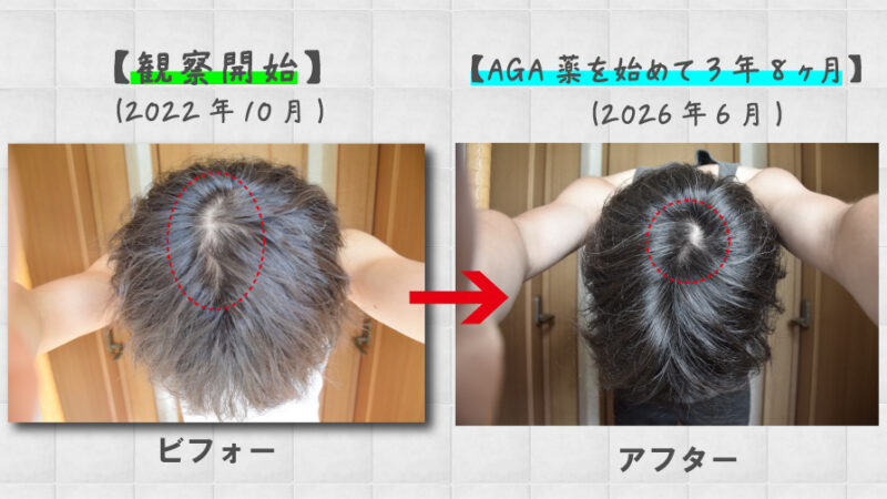 【写真あり】薄毛（AGA）治療を始めて3年8ヶ月の経過報告！発毛剤からAGA薬まで効果を実感！ 