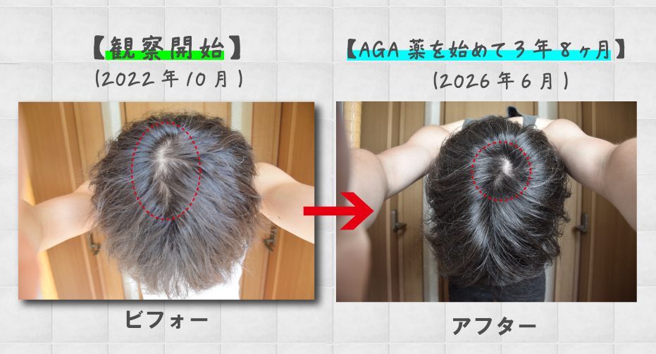 【写真あり】薄毛（AGA）治療を始めて3年8ヶ月の経過報告！発毛剤からAGA薬まで効果を実感！