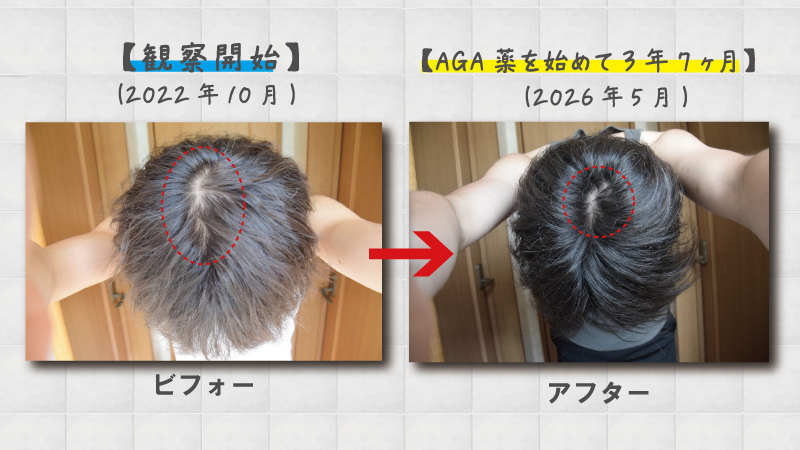 【写真あり】薄毛（AGA）治療を始めて3年7ヶ月の経過報告！発毛剤からAGA薬まで効果を実感！ 