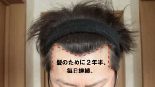 【薄毛（AGA）治療開始2年半！】開始から現在までの効果を実感できた治療内容を2年分の写真で報告！ 