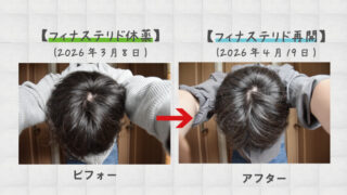 AGA治療でフィナステリドを1ヶ月休薬した結果と、ミノキシジル内服単剤だけを処方できるクリニック 