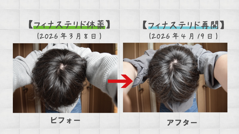 AGA治療でフィナステリドを1ヶ月休薬した結果と、ミノキシジル内服単剤だけを処方できるクリニック 