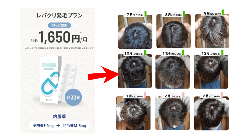 【写真公開】ミノキシジル5mg×フィナステリド9ヶ月！頭頂部の薄毛はどう変わる？ 
